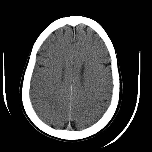 File:Cerebral edema (evolution in time) (Radiopaedia 19418-19440 non-contrast 66).jpg