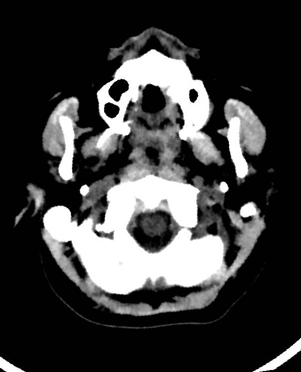 Cerebral edema due to severe hyponatremia (Radiopaedia 89826-106938 Axial non-contrast 10).jpg