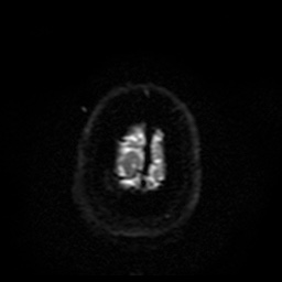 Cerebral embolic infarcts (embolic shower) (Radiopaedia 49837-55108 Axial DWI 2).jpg
