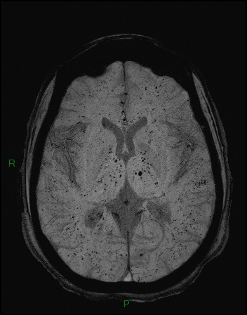 Cerebral fat embolism (Radiopaedia 35022-36525 Axial SWI 19).jpg
