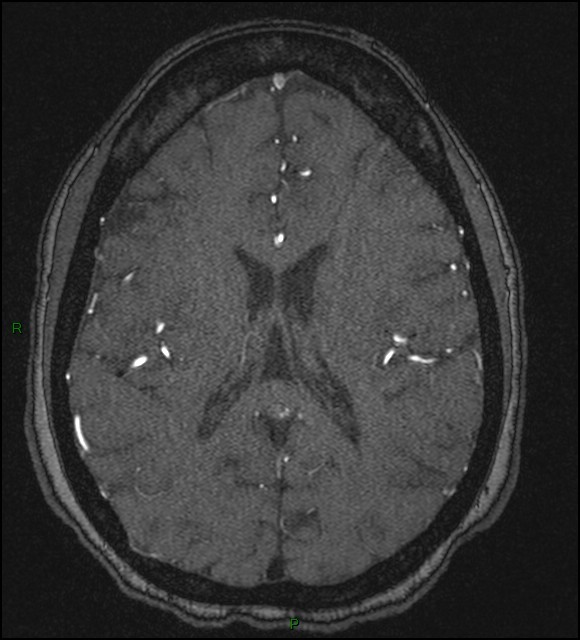 Cerebral fat embolism (Radiopaedia 35022-36525 Axial TOF 126).jpg