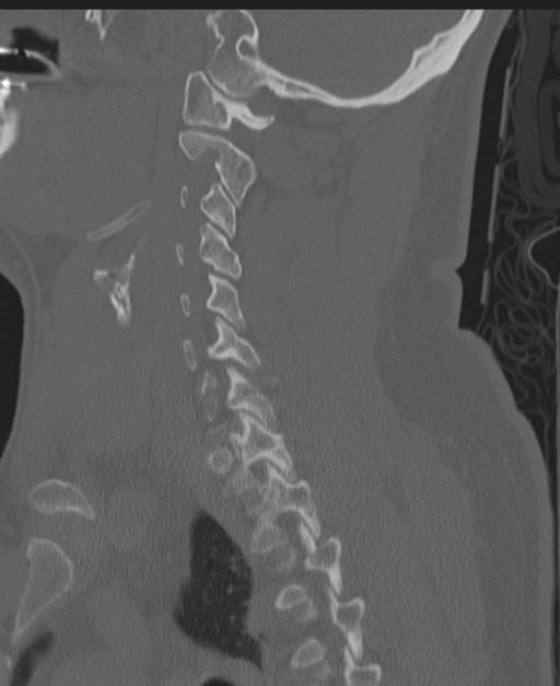 Cerebral hemorrhagic contusions and cervical spine fractures (Radiopaedia 32865-33841 Sagittal bone window 63).jpg