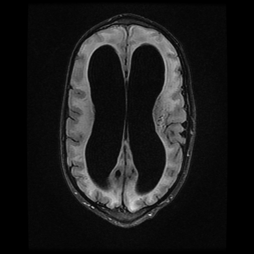File:Cerebral manifestations of mucopolysaccharidosis type I (Radiopaedia 59171-66487 Axial FLAIR 13).jpg