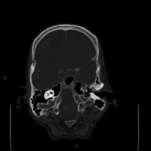 File:Cerebral metastases - breast primary (Radiopaedia 77653-89857 Axial bone window 30).jpg