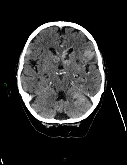 Cerebral metastases - ependymal and parenchymal (Radiopaedia 79877-93131 Axial C+ delayed 30).jpg
