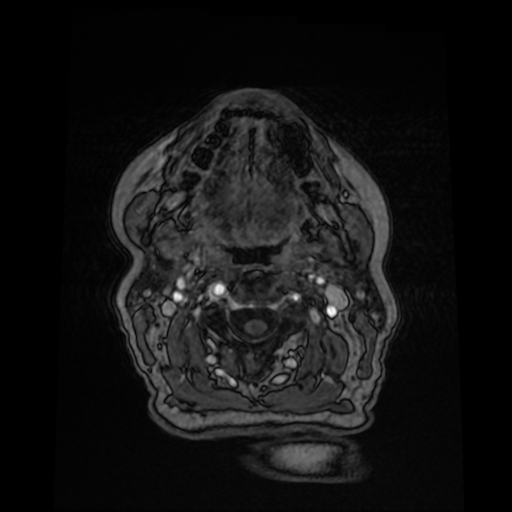 Cerebral metastases - melanoma (Radiopaedia 80972-94522 Axial T1 C+ 7).jpg