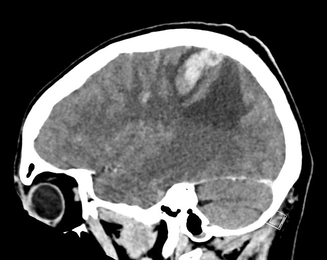 Cerebral metastases - testicular choriocarcinoma (Radiopaedia 84486-99855 F 18).jpg
