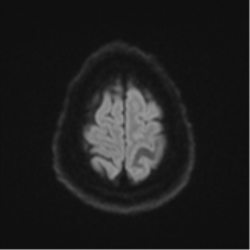Cerebral metastases mimicking multifocal glioblastoma (Radiopaedia 50843-56353 Axial DWI 52).png