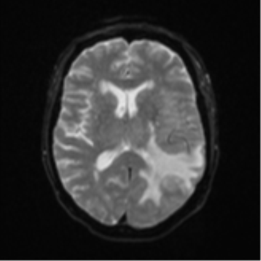 Cerebral metastasis (Radiopaedia 46744-51248 Axial DWI 15).png
