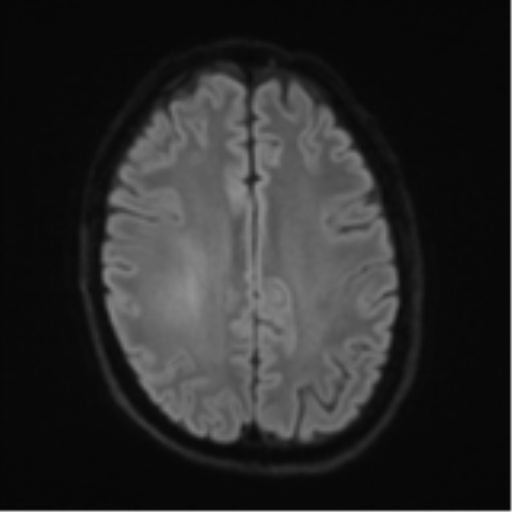 File:Cerebral metastasis - melanoma (Radiopaedia 54718-60954 Axial DWI 51).png
