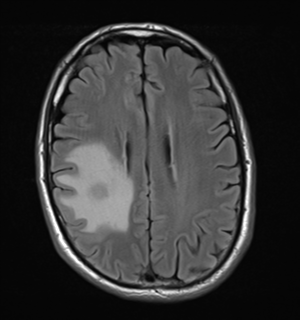 File:Cerebral metastasis - melanoma (Radiopaedia 54718-60954 Axial FLAIR 20).png