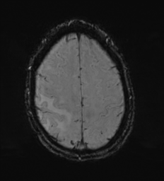File:Cerebral metastasis - melanoma (Radiopaedia 54718-60954 Axial SWI 46).png