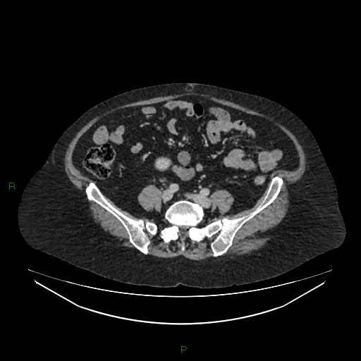 Cerebral metastasis from renal cell carcinoma (Radiopaedia 82306-96378 A 125).jpg