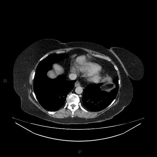 File:Cerebral metastasis from renal cell carcinoma (Radiopaedia 82306-96378 A 17).jpg