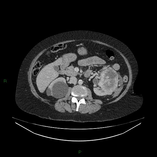 File:Cerebral metastasis from renal cell carcinoma (Radiopaedia 82306-96378 A 76).jpg