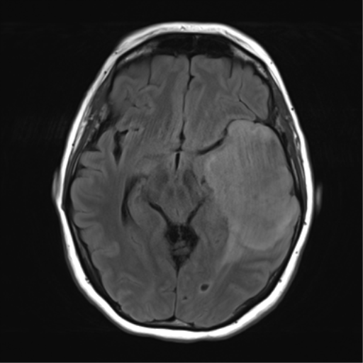 File:Cerebral metastasis mimicking glioblastoma (Radiopaedia 69155-78937 Axial FLAIR 15).png