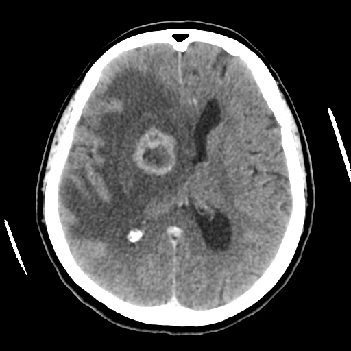 Cerebral metastasis to basal ganglia (Radiopaedia 81568-95412 Axial C+ delayed 33).png