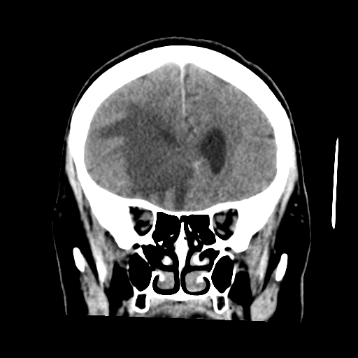 Cerebral metastasis to basal ganglia (Radiopaedia 81568-95412 Coronal C+ delayed 20).png