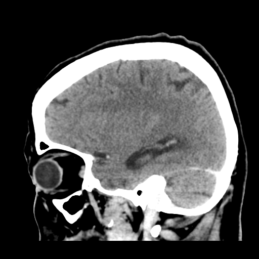 Cerebral metastasis to basal ganglia (Radiopaedia 81568-95412 Sagittal C+ delayed 41).png