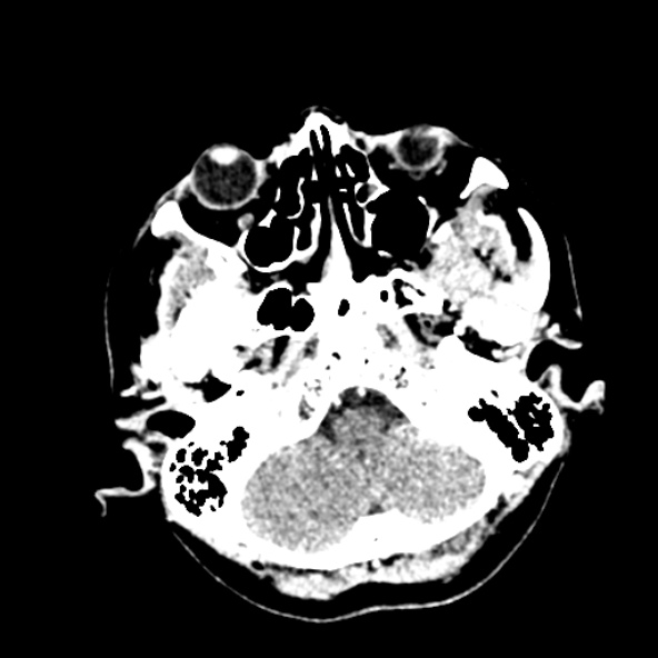 Cerebral ring enhancing lesions - cerebral metastases (Radiopaedia 44922-48818 B 47).jpg