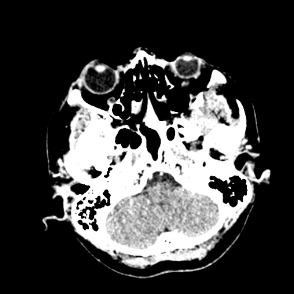 Cerebral ring enhancing lesions - cerebral metastases (Radiopaedia 44922-48818 B 50).jpg