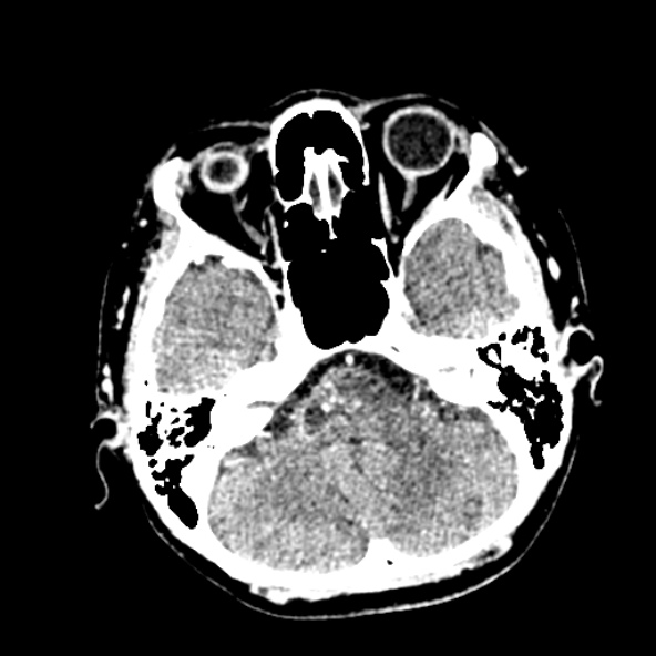 Cerebral ring enhancing lesions - cerebral metastases (Radiopaedia 44922-48818 B 76).jpg