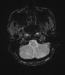 File:Cerebral toxoplasmosis (Radiopaedia 43956-47461 Axial SWI 4).jpg