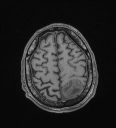 Cerebral toxoplasmosis (Radiopaedia 43956-47461 Axial T1 66).jpg