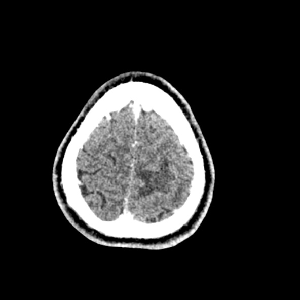 Cerebral toxoplasmosis (Radiopaedia 53993-60131 Axial C+ delayed 65).jpg