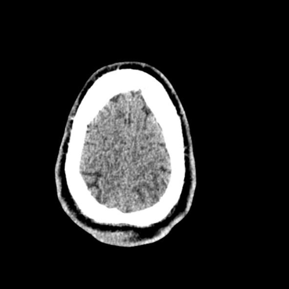 Cerebral toxoplasmosis (Radiopaedia 53993-60131 Axial non-contrast 70).jpg