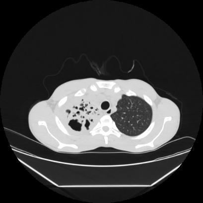 Cerebral tuberculoma (Radiopaedia 80829-94318 Axial lung window 26).jpg