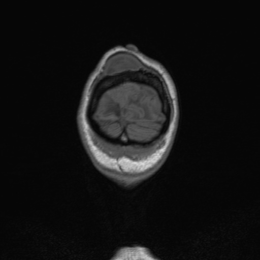Cerebral tuberculosis with dural sinus invasion (Radiopaedia 60353-68090 Coronal T1 171).jpg