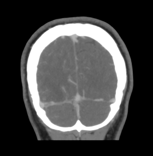 File:Cerebral venous hemorrhagic infarction (Radiopaedia 38461-40550 Coronal MIP VENOGRAM 51).png