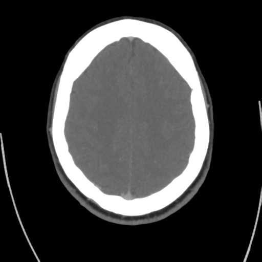 Cerebral venous infarct related to dural venous sinus thromboses (Radiopaedia 35292-36804 Axial C+ delayed 36).png