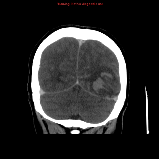 Cerebral venous infarction (Radiopaedia 12404-20735 B 66).jpg