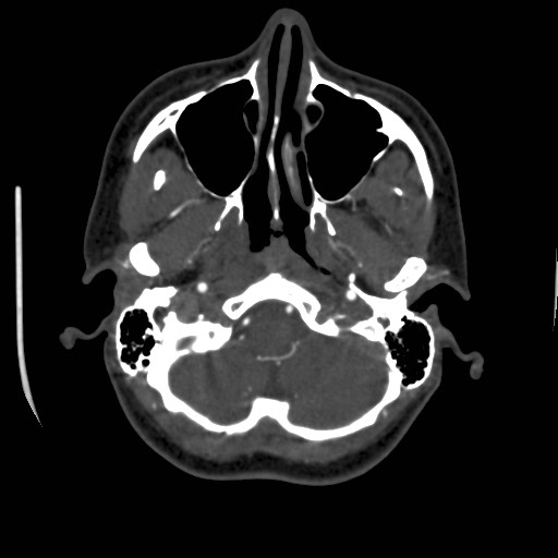 Cerebral venous sinus thrombosis (Radiopaedia 40619-43227 A 31).jpg
