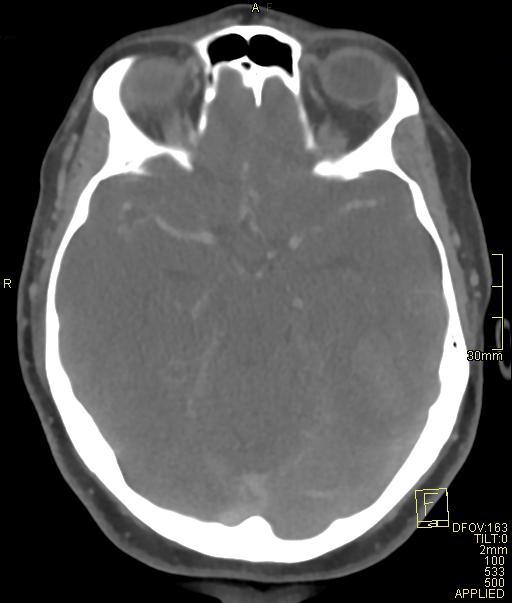 Cerebral venous sinus thrombosis (Radiopaedia 91329-108965 Axial venogram 33).jpg
