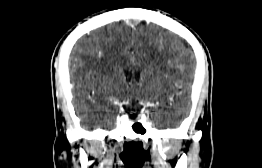 Cerebral venous thrombosis (CVT) (Radiopaedia 77524-89685 C 27).jpg