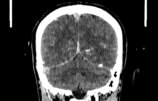 Cerebral venous thrombosis (CVT) (Radiopaedia 77524-89685 C 49).jpg