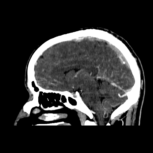 File:Cerebral venous thrombosis (CVT) (Radiopaedia 77524-89685 Sagittal CTV 24).jpg