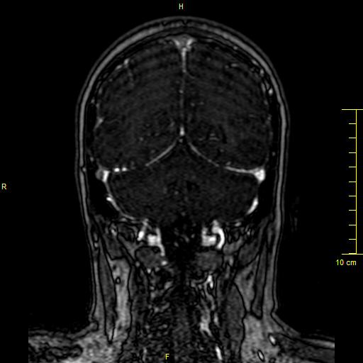 Cerebral venous thrombosis (Radiopaedia 23288-23351 MRV 123).JPG