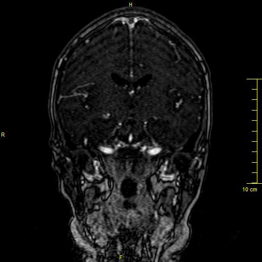 File:Cerebral venous thrombosis (Radiopaedia 23288-23351 MRV 74).JPG