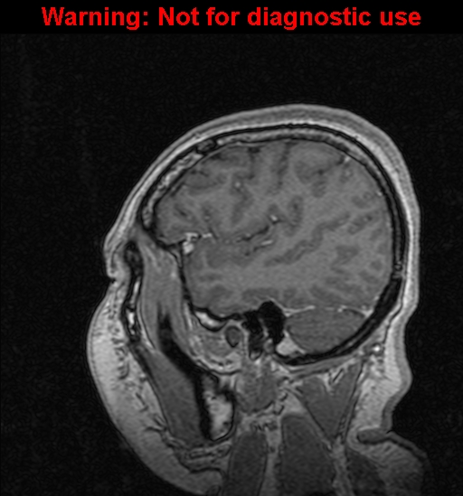 Cerebral venous thrombosis (Radiopaedia 37224-39208 Sagittal T1 C+ 121).jpg