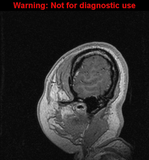 File:Cerebral venous thrombosis (Radiopaedia 37224-39208 Sagittal T1 C+ 139).jpg