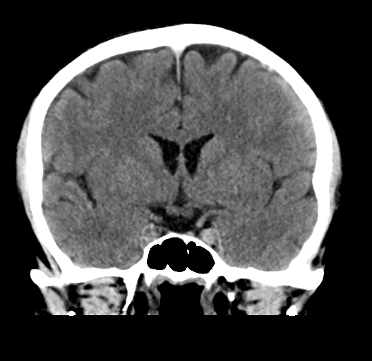 File:Cerebral venous thrombosis (Radiopaedia 38392-40467 Coronal non-contrast 17).png
