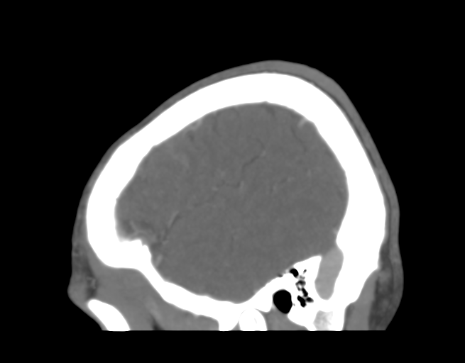 Cerebral venous thrombosis (Radiopaedia 38392-40467 D 8).png