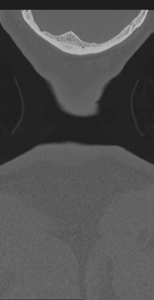 Cervical canal stenosis due to ossification of the posterior longitudinal ligament (Radiopaedia 47260-51823 Coronal bone window 82).png