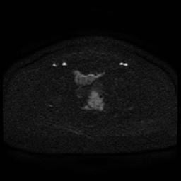 Cervical carcinoma (Radiopaedia 85405-101028 Axial DWI 68).jpg