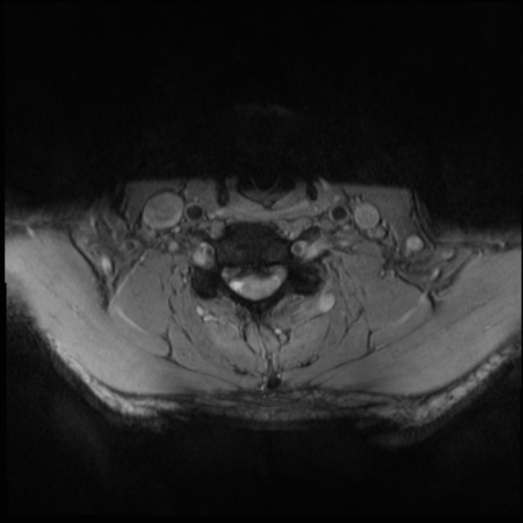 File:Cervical disc extrusion (Radiopaedia 53950-60077 Axial T2 22).jpg