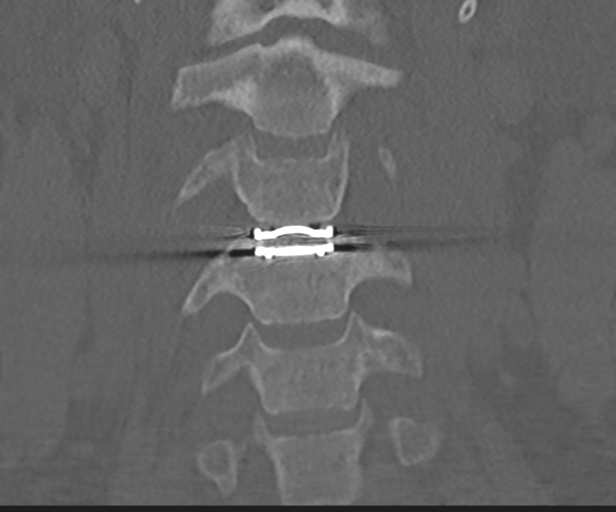 File:Cervical disc replacement (Radiopaedia 44025-47541 Coronal bone window 15).png